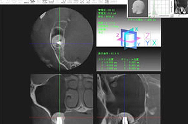 歯科用マイクロCT