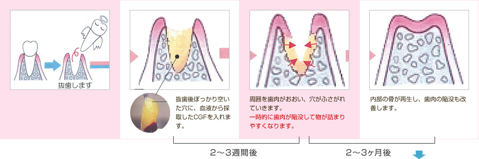 CGFコラーゲンを入れた場合