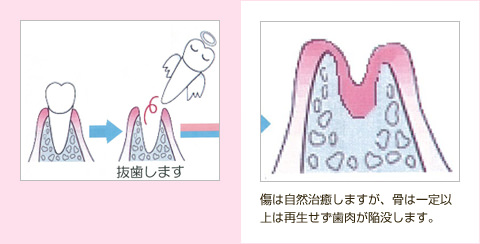 CGFコラーゲンを入れない場合