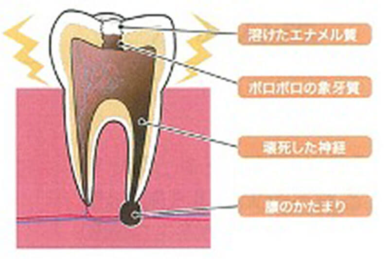 根管治療とは？