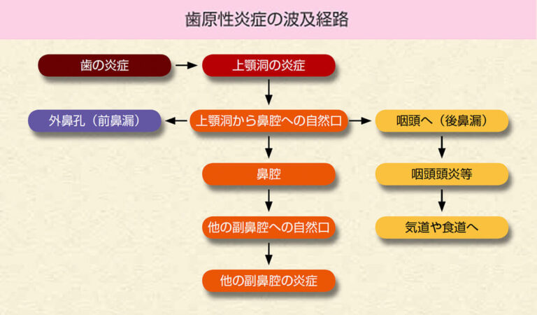 歯原性炎症の波及経路